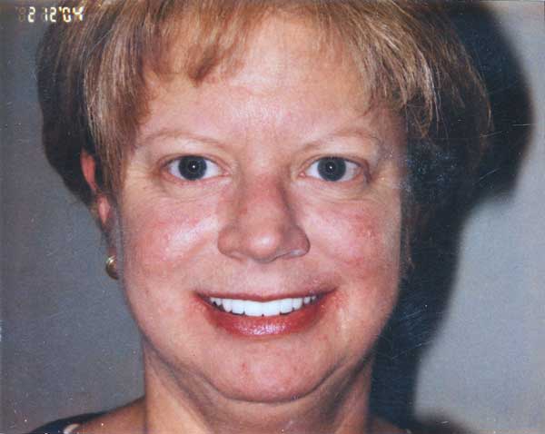 dora-after